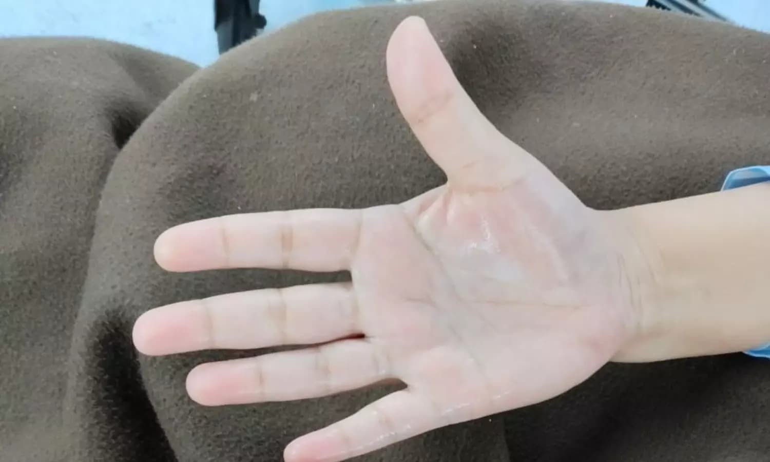 Mumbai's Jaslok Hospital Successfully Treats Young Ex-Airhostess for Palmar Hyperhidrosis with Minimally Invasive Procedure