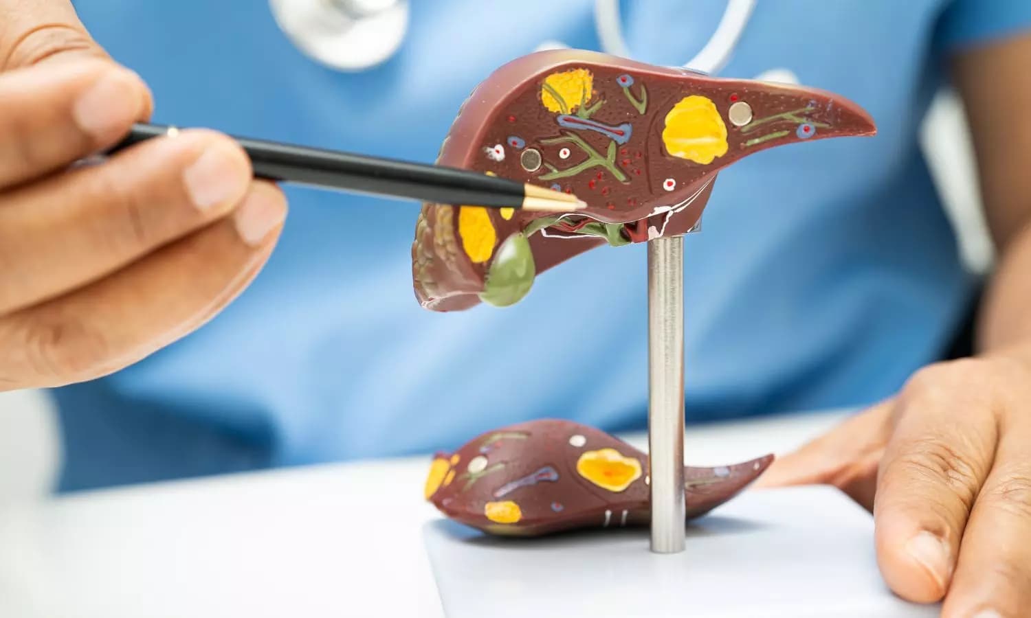 Delhi NCR Doctors Treat Liver Cancer with Minimally Invasive Procedure